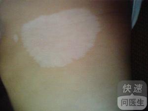 白癜風的癥狀一般都有什么表現