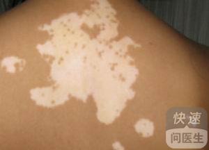 治療白癜風的藥物偏方,預防白癜風的方法