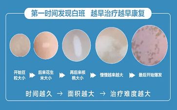 白斑郭廣英解讀哪些人更容易得白斑